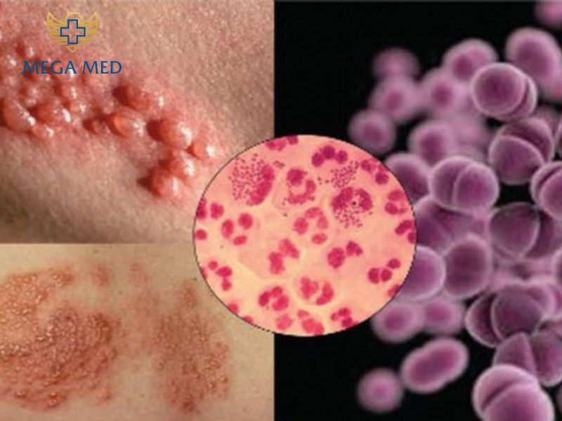 Hình ảnh các biểu hiện bệnh lây qua đường tình dục